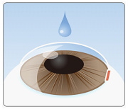 点眼麻酔（目薬による麻酔）を行った後、角膜（黒目と白目の境目あたり）を約３ｍｍ切開します。