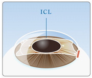 切開した部分から、ＩＣＬを眼の中に挿入します。 