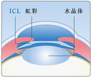 ・虹彩と水晶体の間にＩＣＬをインプラントします。・切開した角膜の部分は、自然と閉鎖します。 