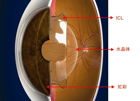 ICL(フェイキックIOL)手術について