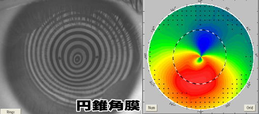 [円錐角膜]