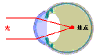 図１　近視 