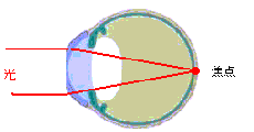 図３　OKレンズで矯正後