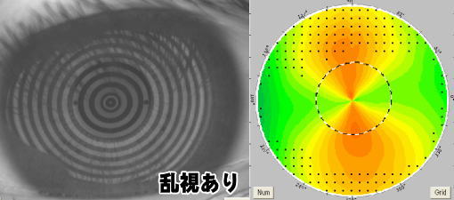 [乱視ありの角膜形状]